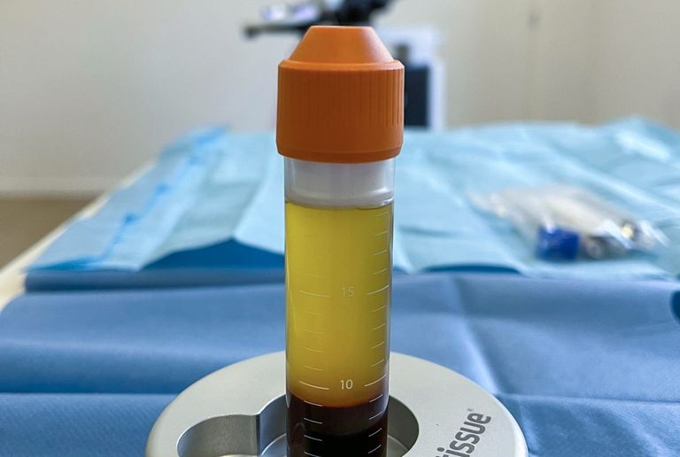 Infiltración PRP