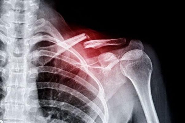 Tratamiento de fracturas