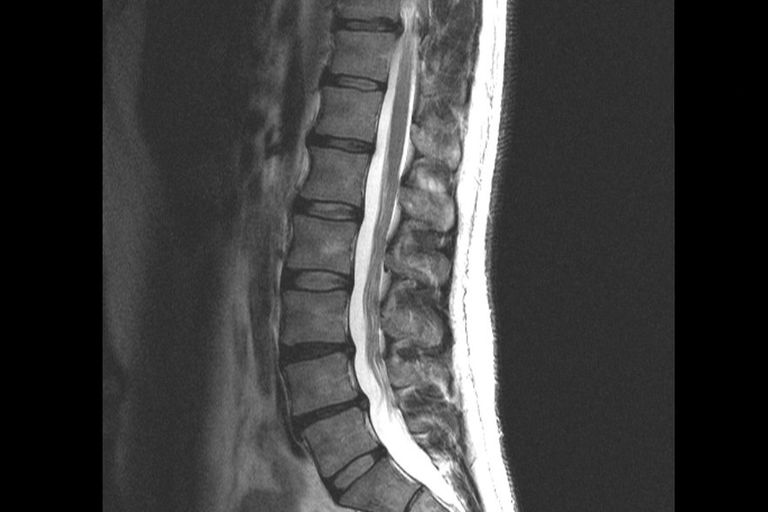 Columna Vertebral